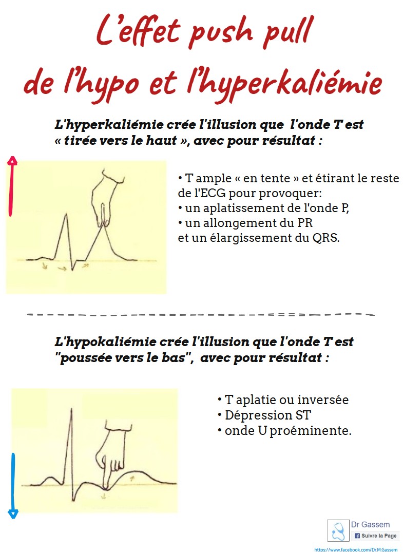 Hypo et hyperkaliémie (à l'ECG)